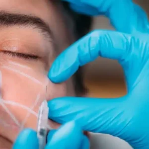 Inductores de Colageno Ellansé/Radiesse